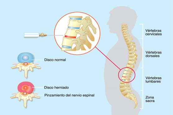 Tratamiento de la Lumbociática y Hernia de Disco con Ozono